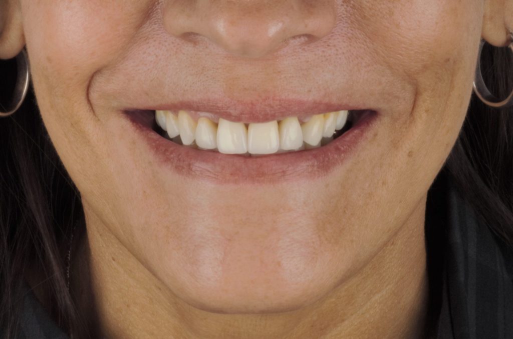 Image 10 - After, Close-up photo of upper teeth of a woman, showing white, well-cleaned teeth
