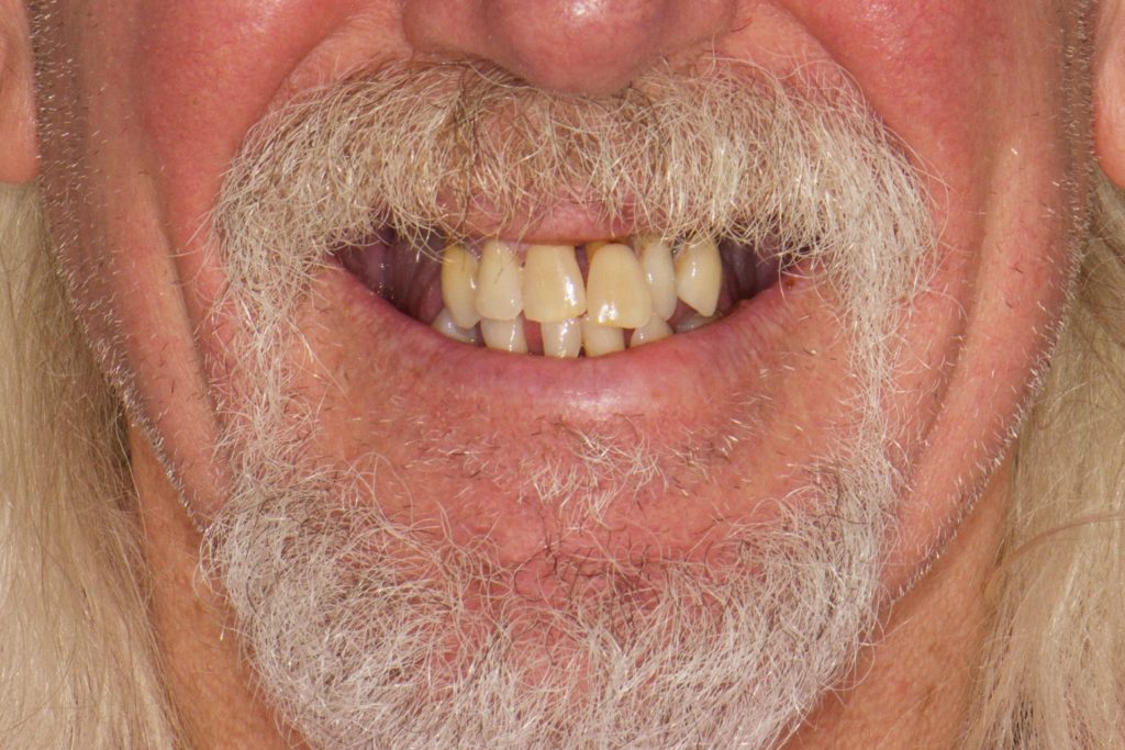 Image 12 - Before, Close-up photo of upper and lower teeth of a man, photo shows yellow disoriented teeth