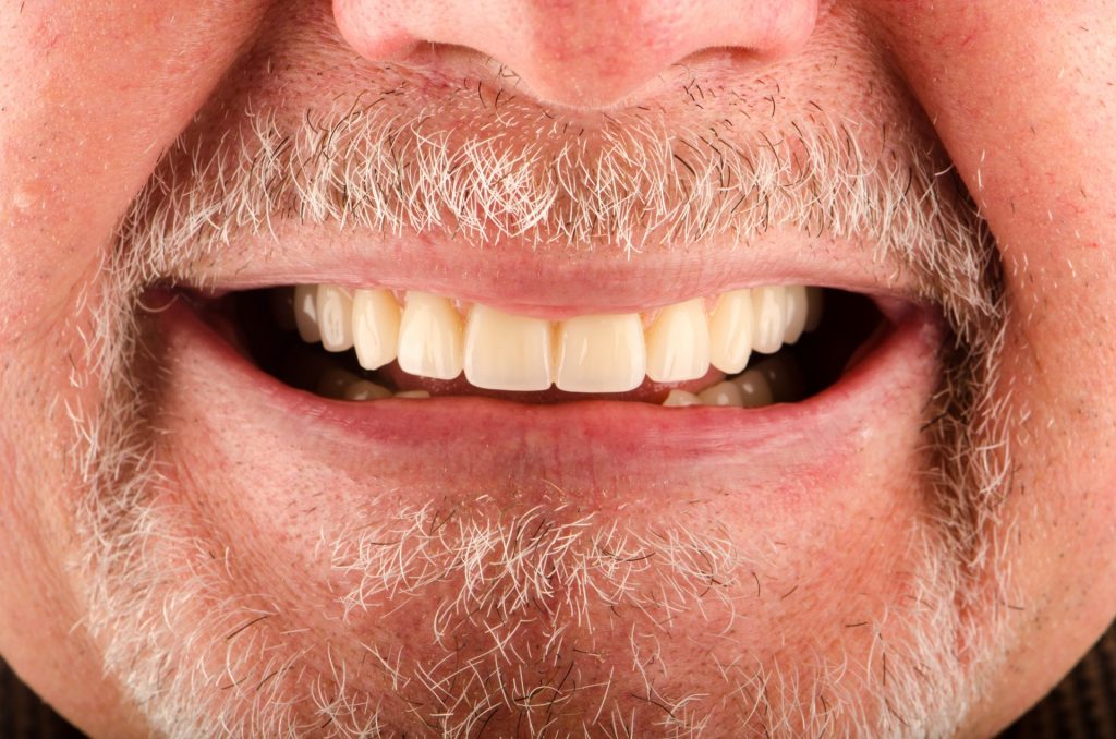 Image 13 - After, Close-up photo of a smiling man's face, photo shows beautiful upper teeth and lower teeth are slightely visible