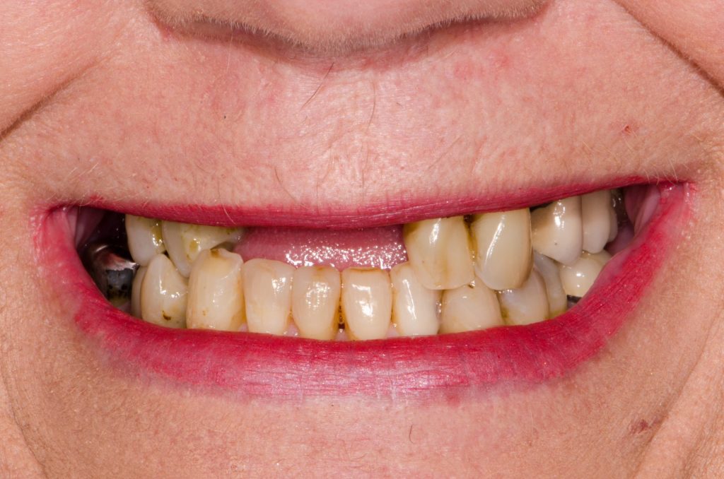 Image 4 - Before (Showing upper and lower teeth - front teeth missing in upper jaw, before the procedure)