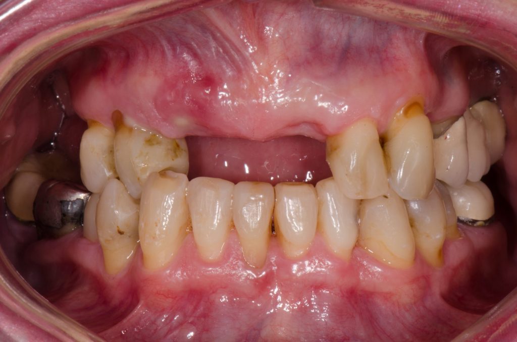 Image 4B - Before (Showing upper and lower teeth - front teeth missing in upper jaw, before the procedure)