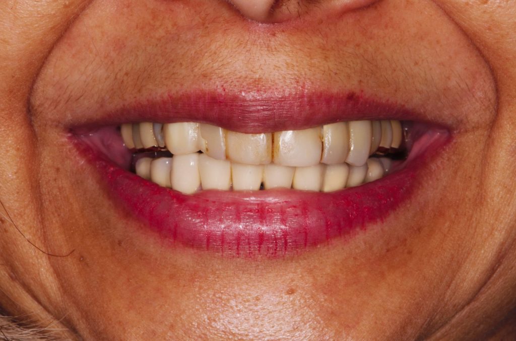 Image 9 - Before, Close photo of teeth of a woman, teeth are yellowish and not aligned properly