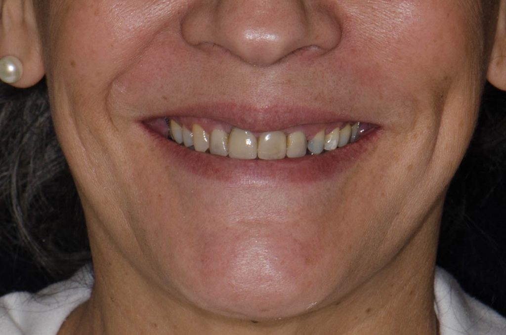 Image 10 - Before, Close-up photo of upper teeth of a woman, Teeth are yellowish-brown, need professional cleaning