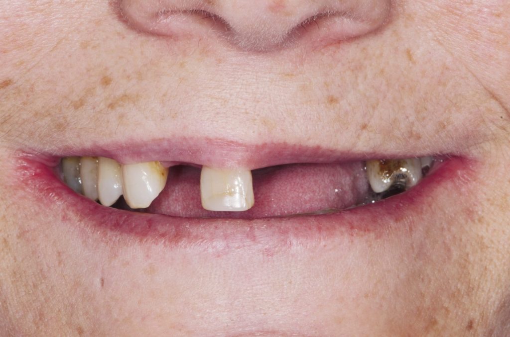 Image 11 - Before, Close-up photo of upper teeth of a man, photo shows some decayed teeth and multiple teeth are missing