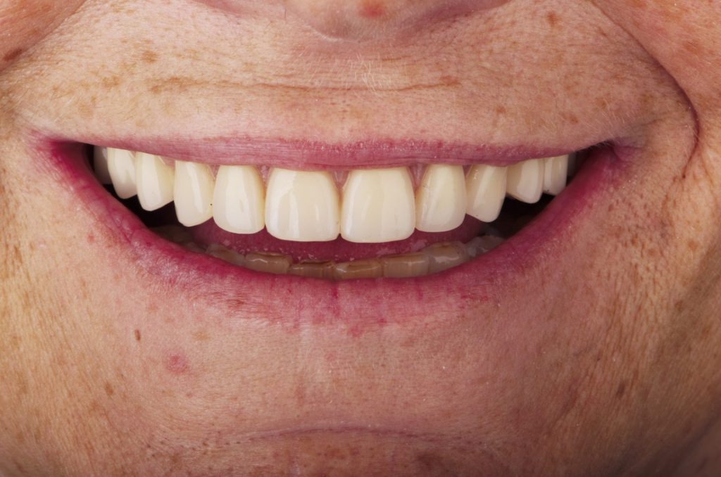 Image 11 - After, Close-up photo of upper teeth of a smiling man, photo shows beautiful white teeth after the procedure