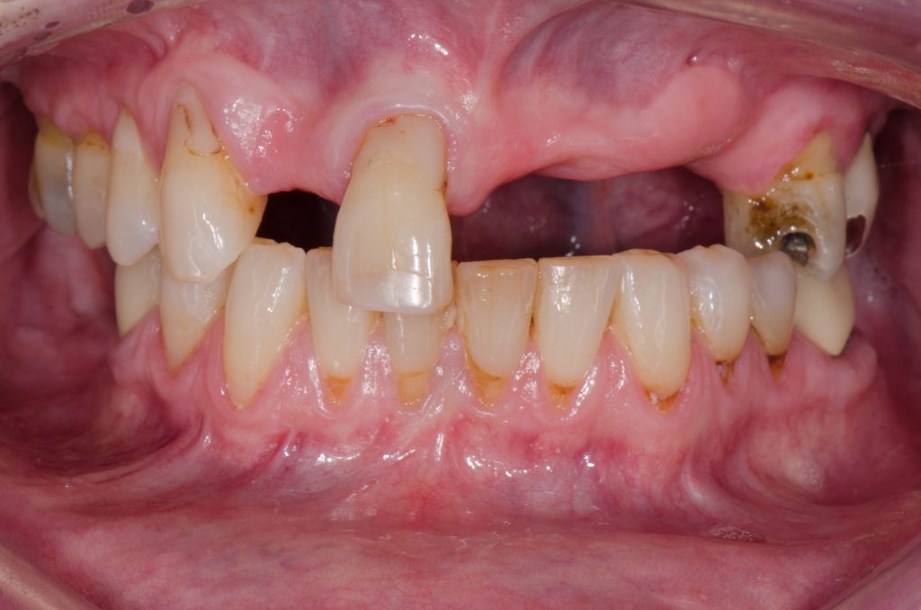 Image 11B - Before, Close-up photo of upper and lower teeth, photo shows multiple missing