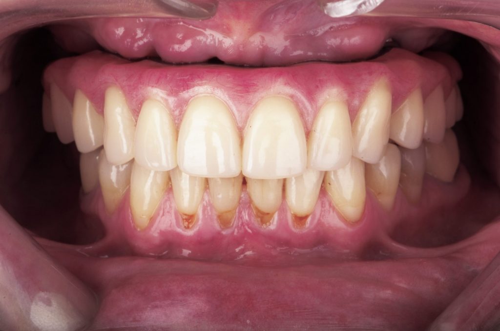 Image 11B - After, Close-up photo of upper and lower teeth , photo shows all the the teeth restored using a denture