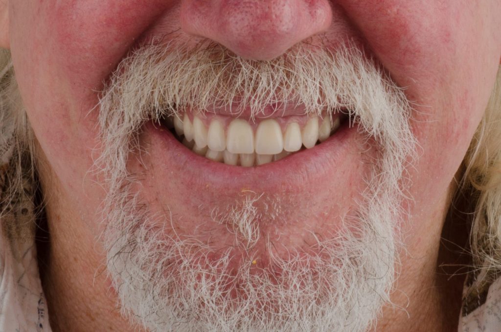 Image 12 - After, Close-up photo of upper and lower teeth of a man, photo shows all the teeth fixed after the procedure