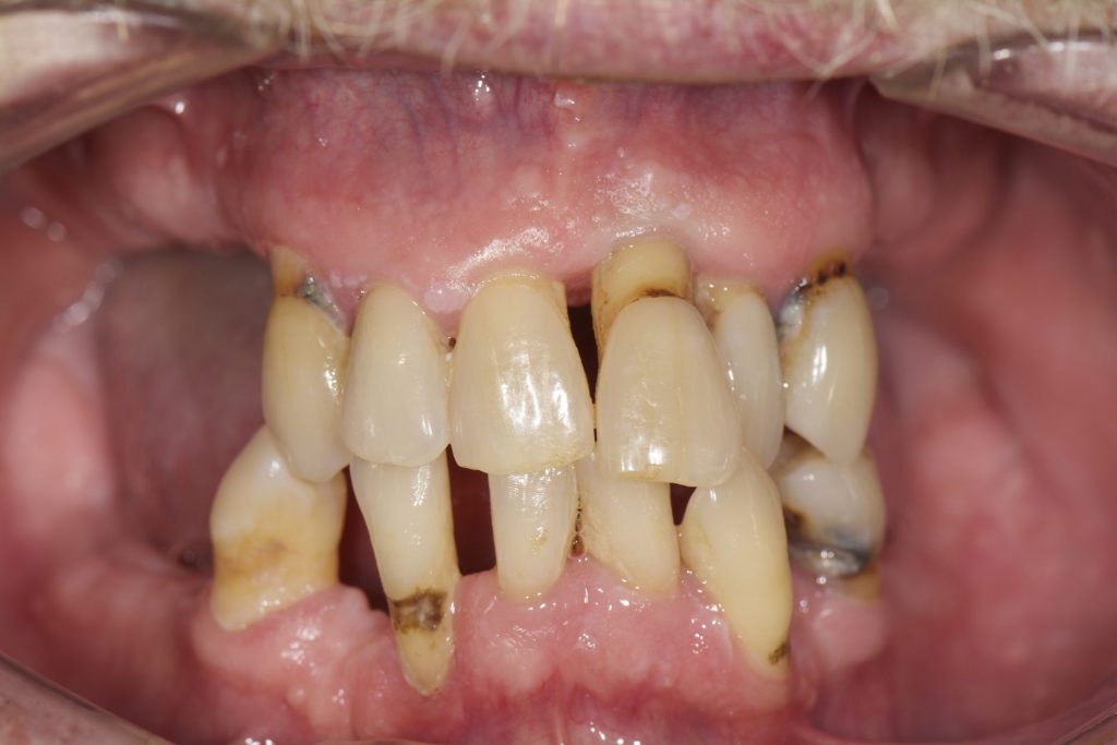 Image 12B - Before, Close-up photo of upper and lower teeth, photo shows few remaining yellow and disoriented teeth