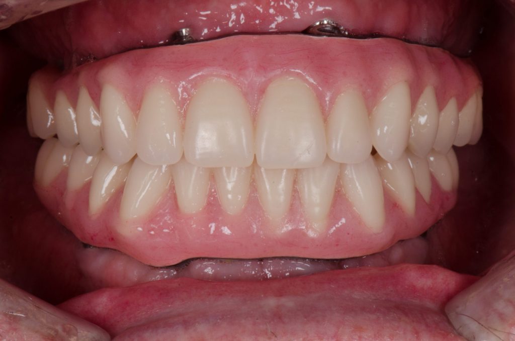 Image 12B - After, Close-up photo of upper and lower teeth, photo shows upper and lower dentures.