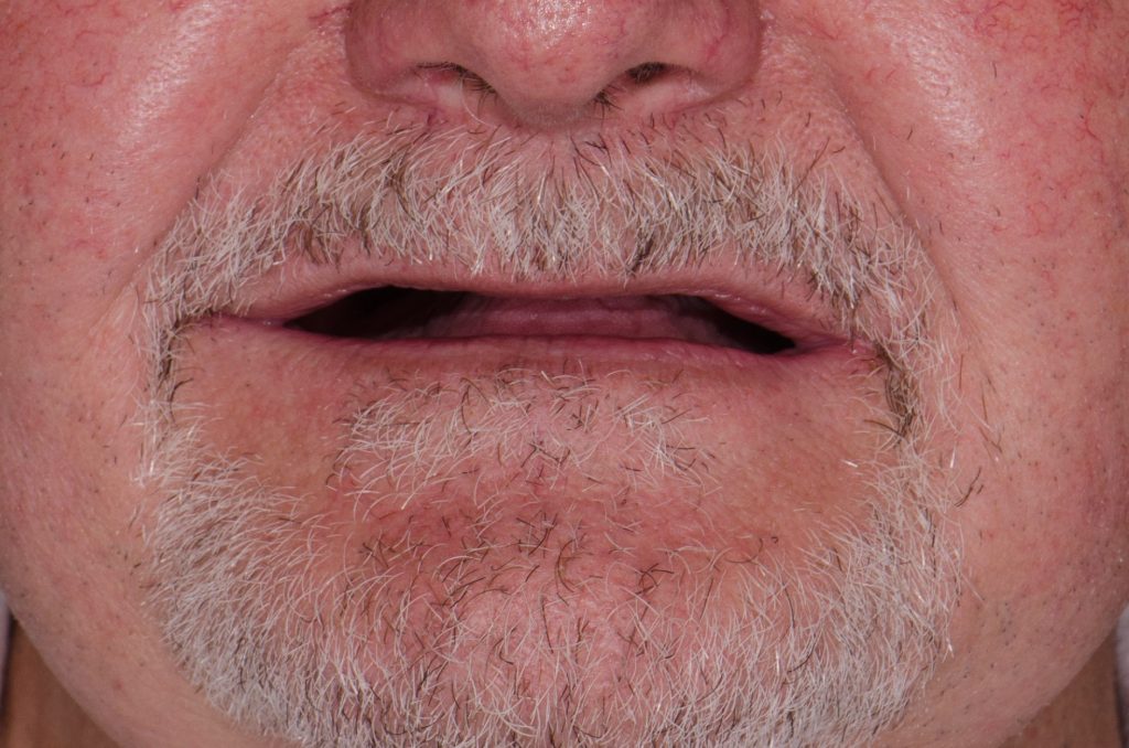 Image 13 - Before, Close-up photo of a man's face, all the teeth are absent