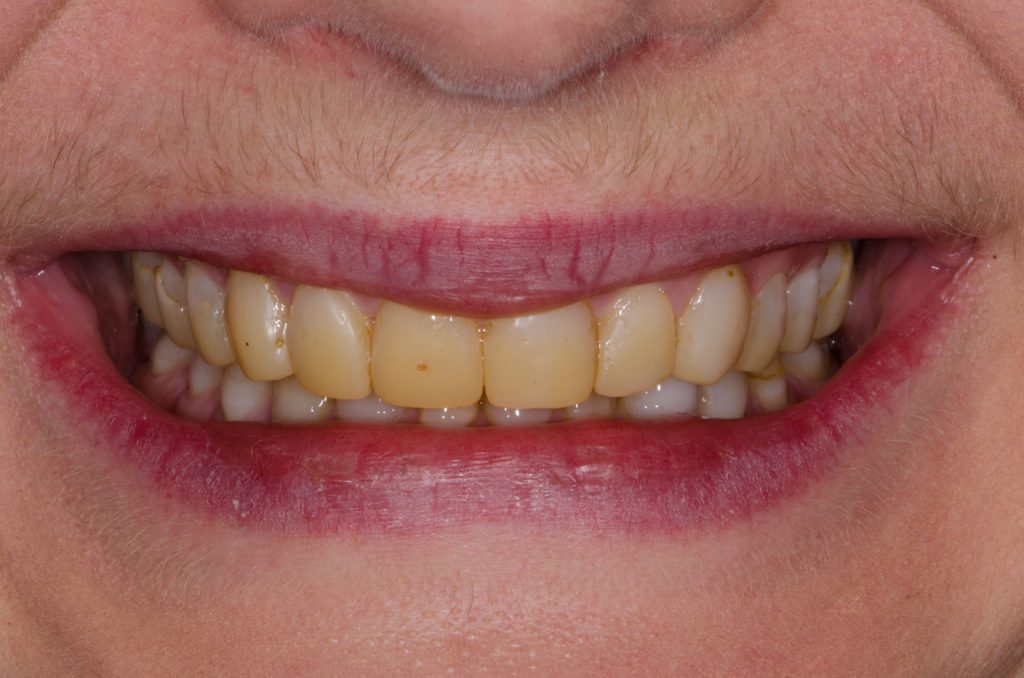 Image 2 -Before (Showing upper and lower teeth before the procedure)