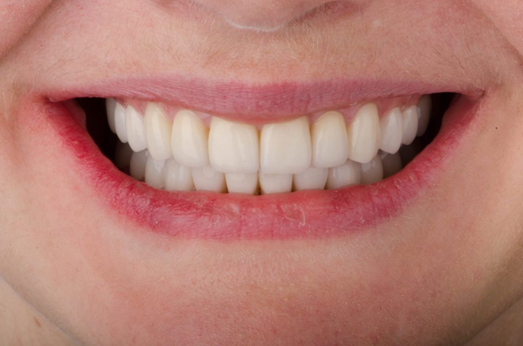 Image 2 -After (Showing upper and lower teeth after the procedure)