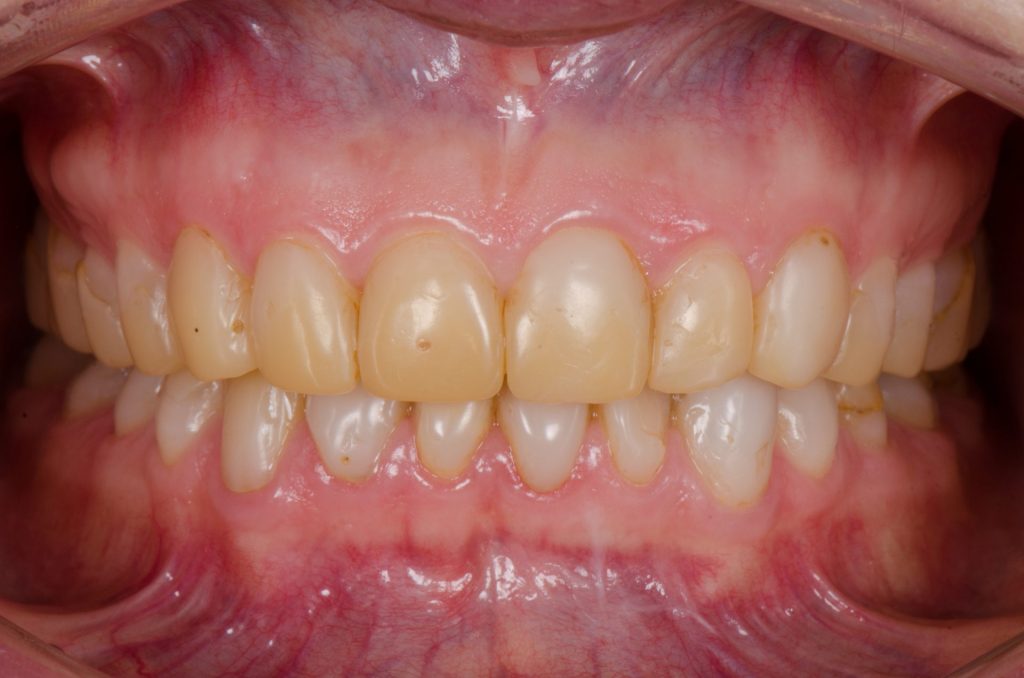 Image 3 - Before (Showing yellow teeth - upper and lower, before the procedure)