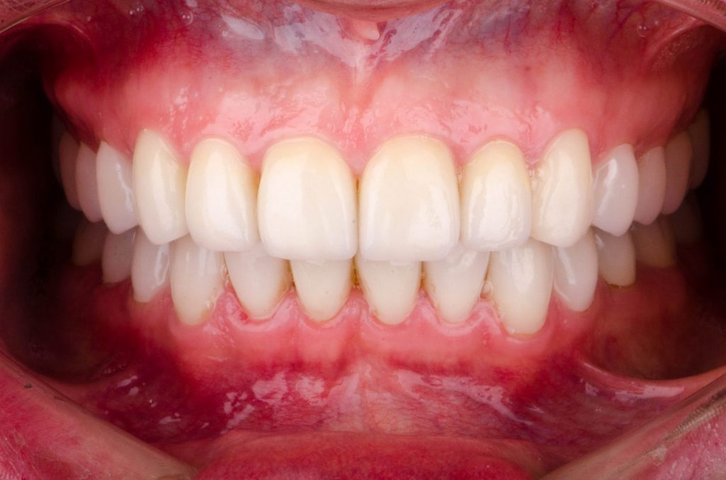 Image 3 - After (Showing white teeth - upper and lower, after the procedure)