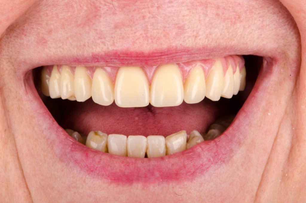 Image 4B - After (Smiling face, showing upper and lower teeth - after the procedure)