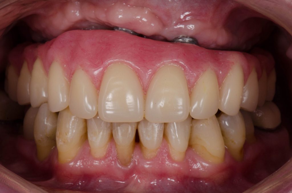 Image 4B - After (Showing upper and lower teeth - after the procedure)