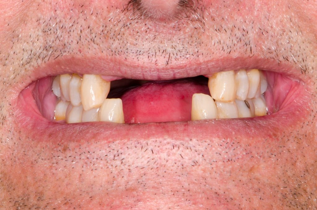 Image 8 - Before, Close photo of teeth, Upper and lower front teeth are missing