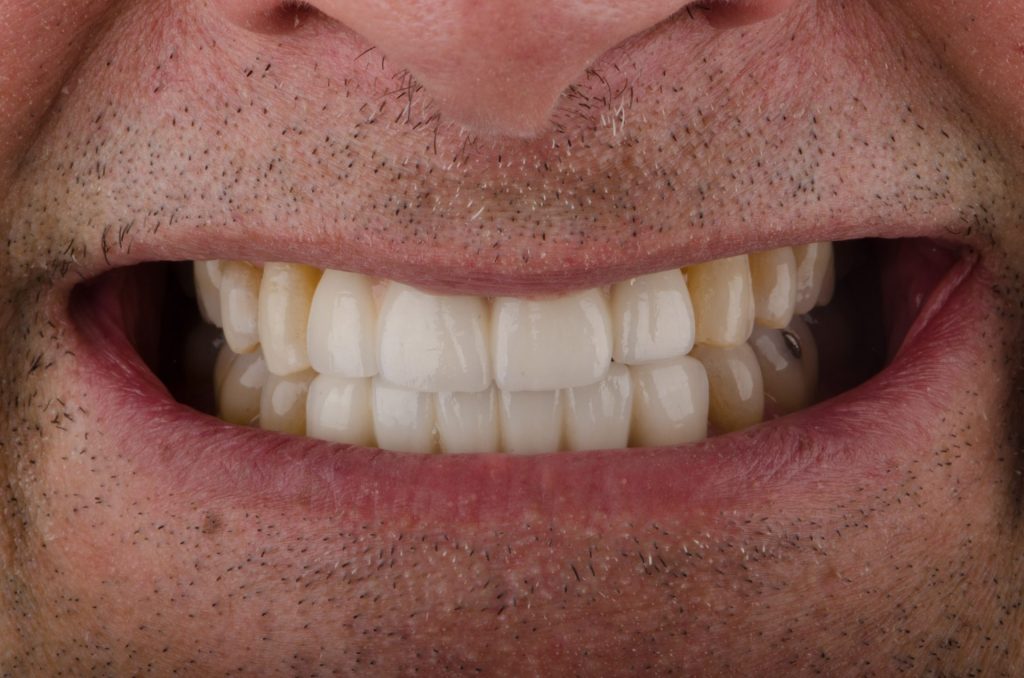 Image 8 - After, Close photo of teeth, Showing all restored teeth, upper and lower