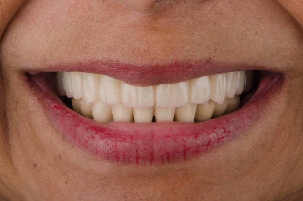 Image 9 - After, Close-up photo of teeth of a woman, Showing beautiful white teeth after the procedure