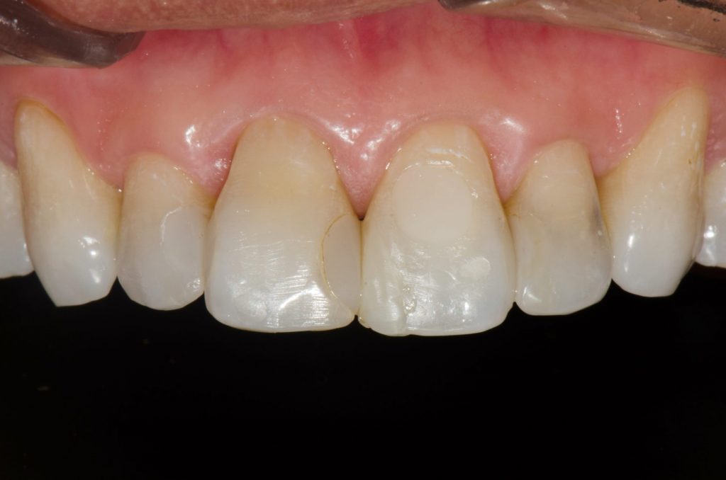 Image 1-Before (Showing upper teeth before the procedure)