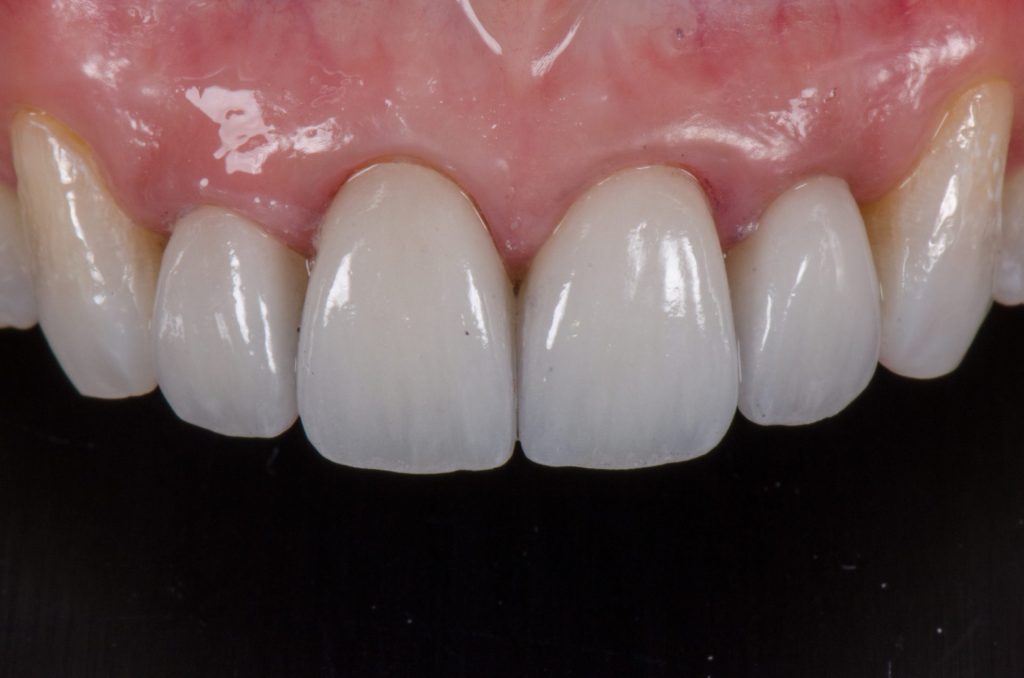 Image 1 -After (Showing upper teeth after the procedure)