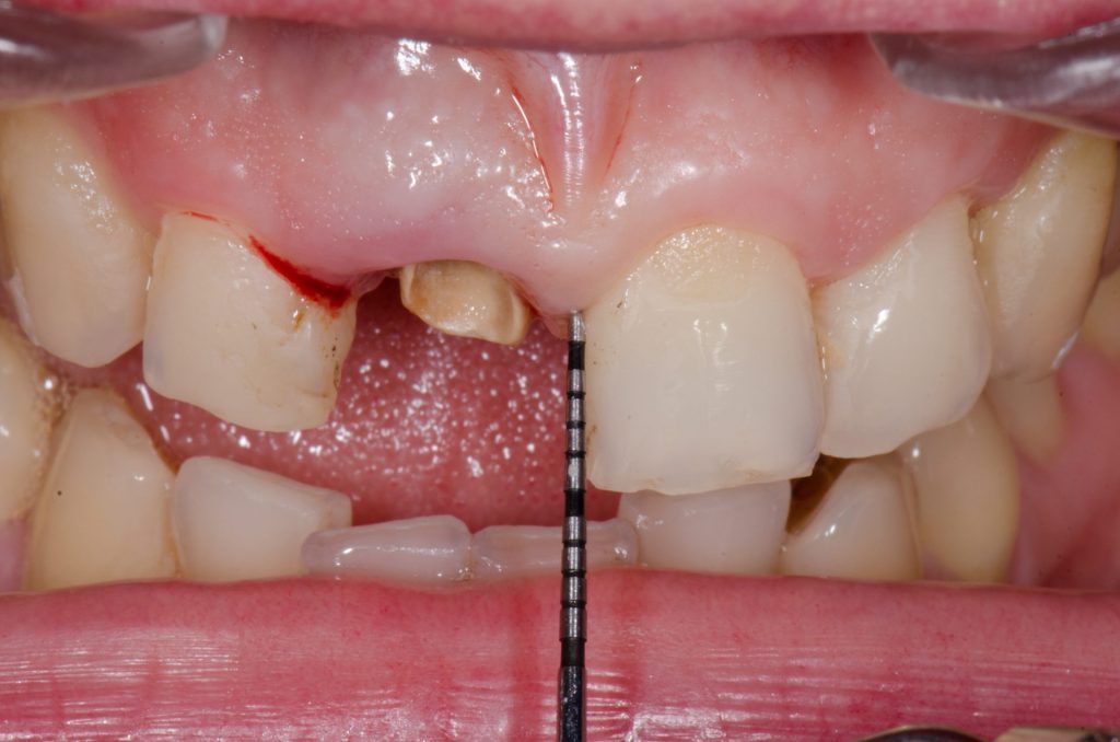 Image 5 - One teeth missing from upper side, showing the picture before the procedure