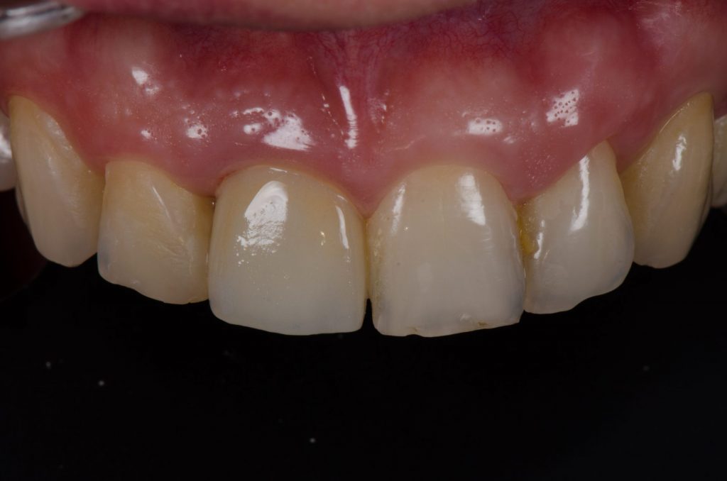 Image 5 - Upper teeth fixed, showing the picture after the procedure