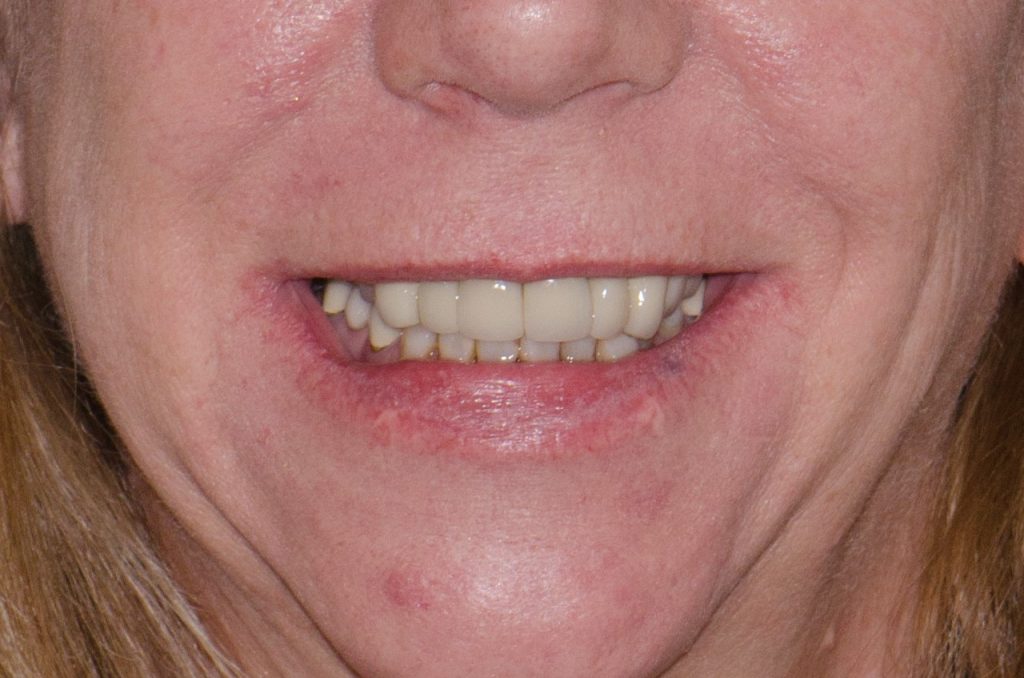 Image 6 - Before - face closeup showing lower and upper teeth