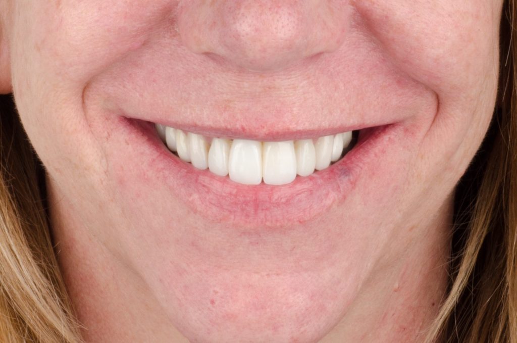 Image 6 - After - Smiling face closeup showing white upper teeth