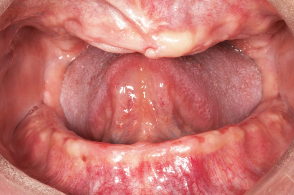Image 7 - Before, Photo of inside the mouth, all teeth missing