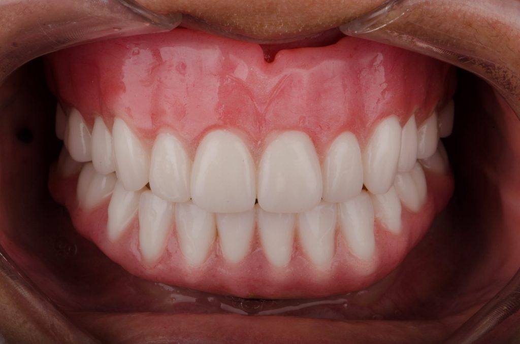 Image 7 - After , Closup of the face with new dentures (upper and lower)